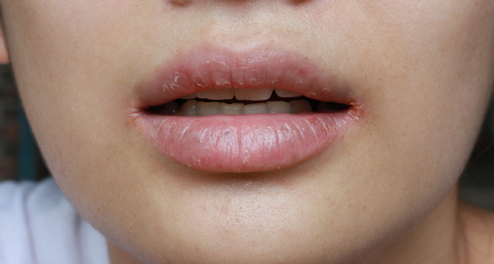 close up of chapped, cracked lips caused wound on the corner of the lips: dry skin problem with mouth disease, Angular cheilitis