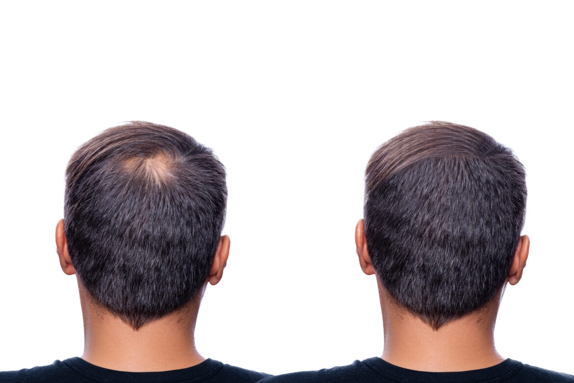 Concept of hair fall and hair regrowth